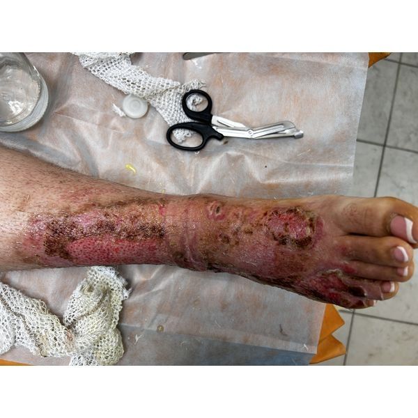 Перевязка через 5 недель Перевязка через 5 недель