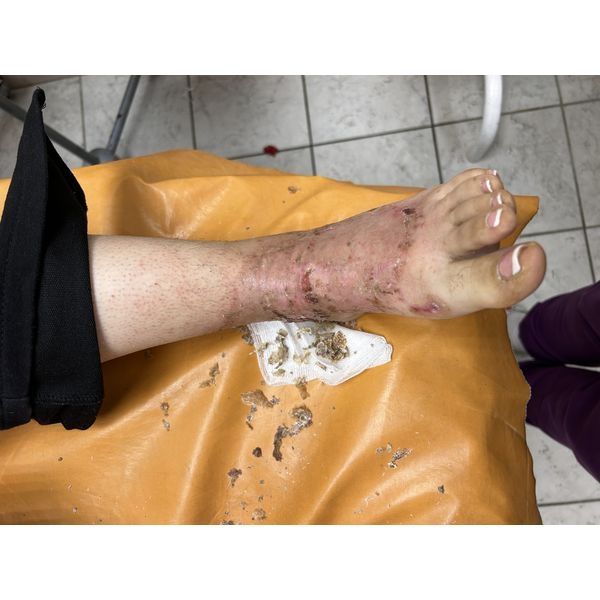 Перевязка через 5 недель Перевязка через 5 недель