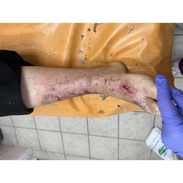 Перевязка через 5 недель Перевязка через 5 недель