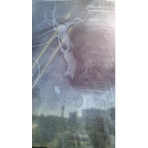 Первая фистулография: конкременты в холедохе