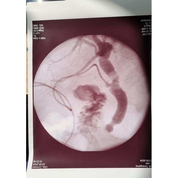 Контрольная фистулография