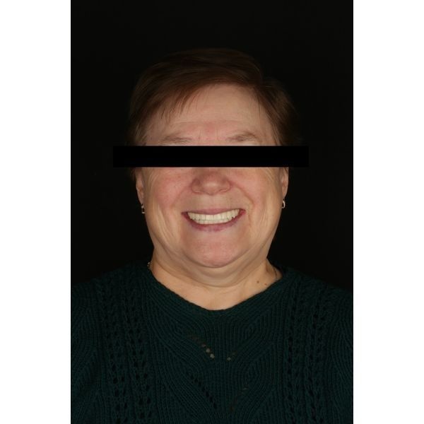 Состояние зубов после лечения Состояние зубов после лечения