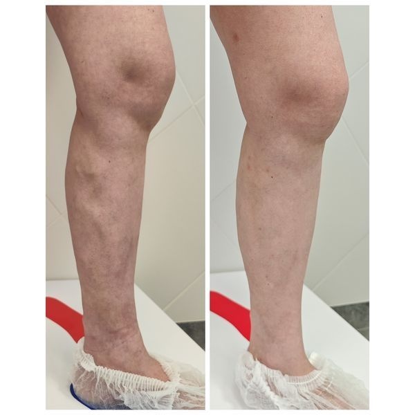 Состояние левой ноги до лечения и через месяц после лечения