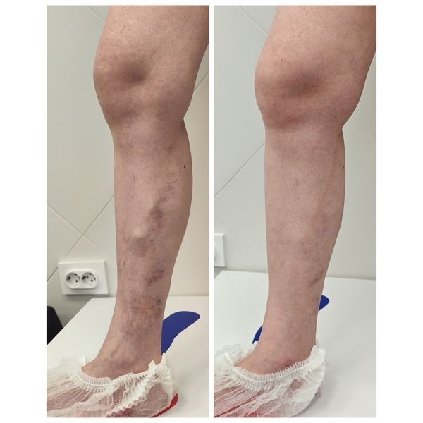 Состояние правой ноги до лечения и через месяц после лечения