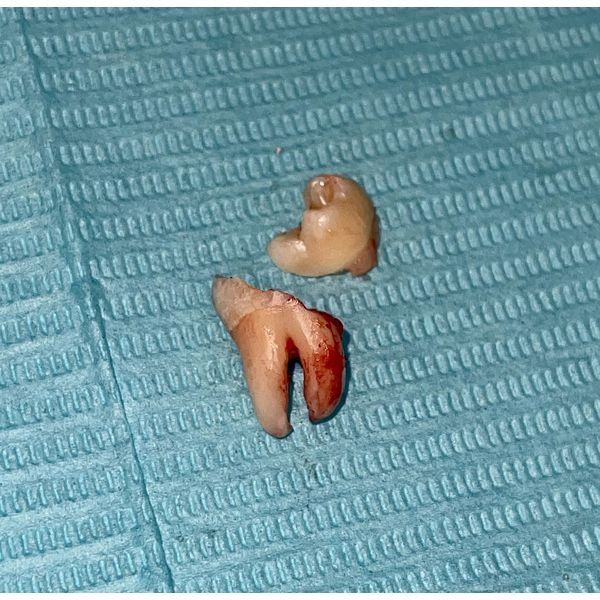 Удалённый зуб 