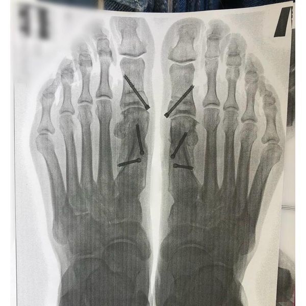 Рентгенограмма обеих стоп в прямой проекции через 6 месяцев после операции Рентгенограмма обеих стоп в прямой проекции через 6 месяцев после операции