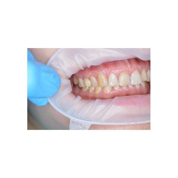 До лечения: трещина на зубе со стороны десны