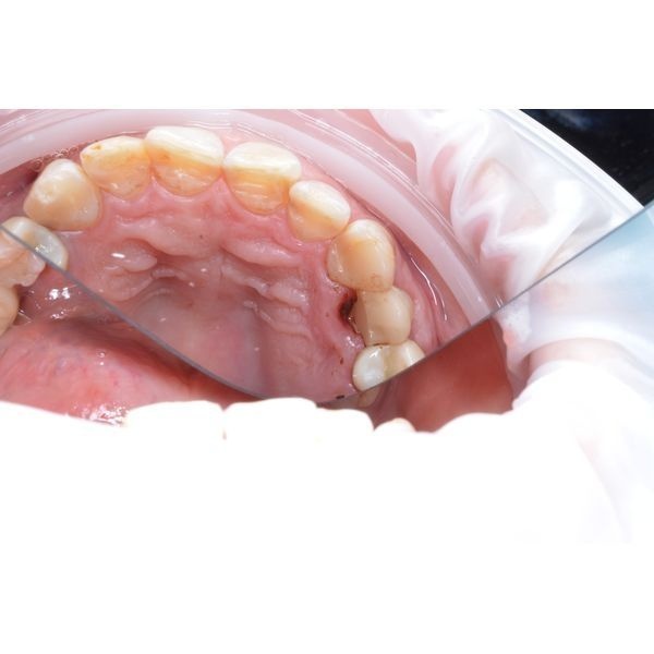 До лечения: перелом зуба, в том числе корня