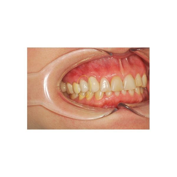 После лечения: восстановленный зуб неотличим от соседних