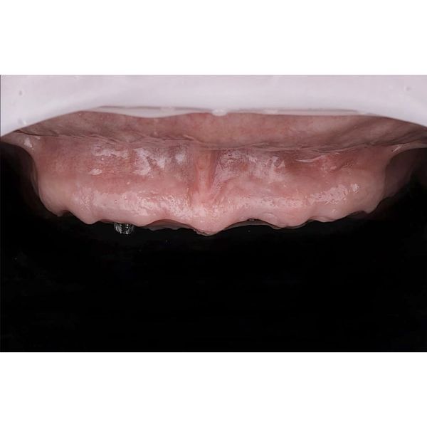 Верхняя челюсть до лечения