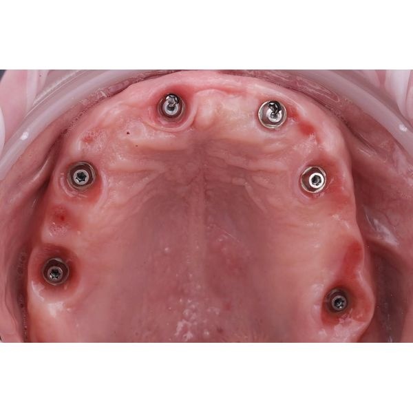 Установка имплантов