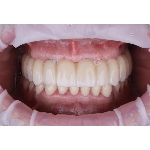 Готовый зубной протез с опорой на импланты