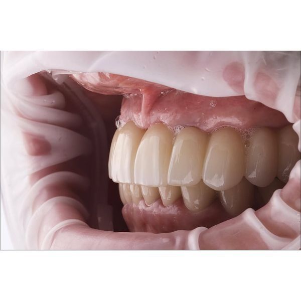 Готовый зубной протез с опорой на импланты (вид сбоку)