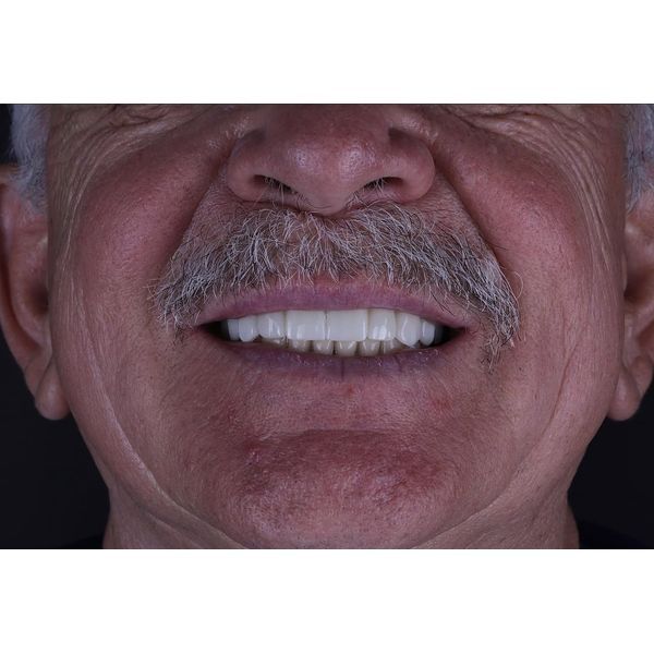 Эстетика и функциональность полости рта восстановлены