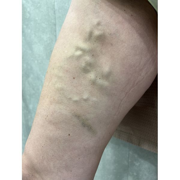 Запущенный варикоз на внешней стороне правой ноги