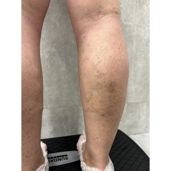 Правая нога после лечения варикоза лазером