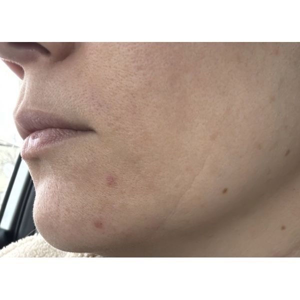 Кожа после лечения