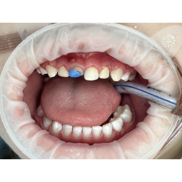 После лечения