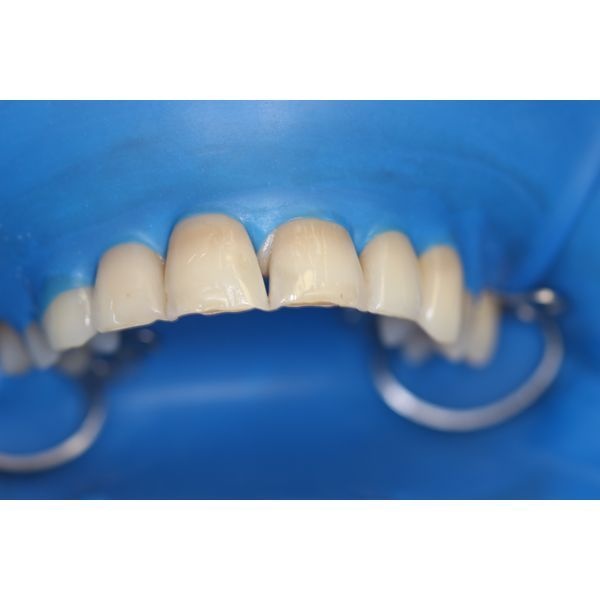 Нарушение эмалевого края верхних резцов с оголением дентина