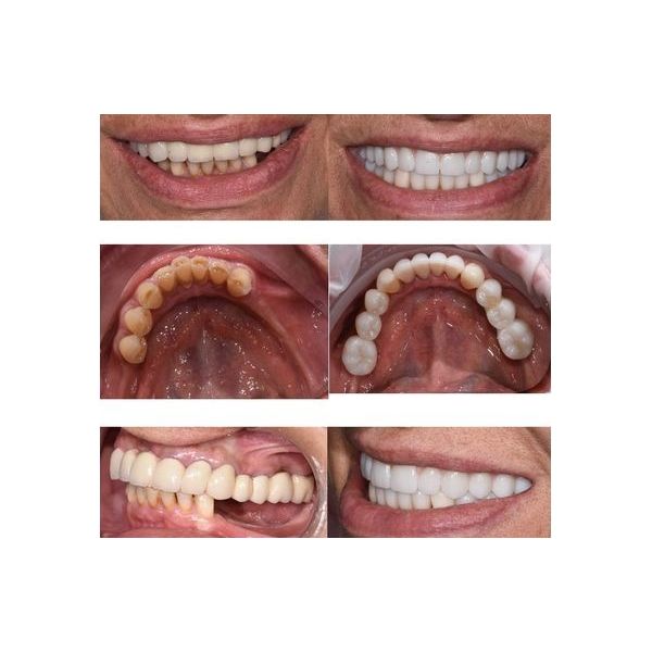 До и после установки постоянных имплантов и протезов