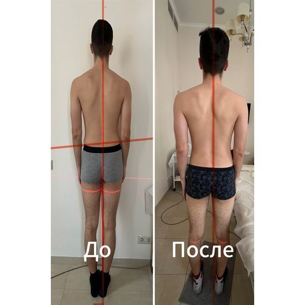 Результат лечения сколиоза
