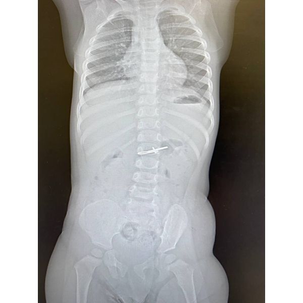 Инородное тело на обзорном снимке органов брюшной полости