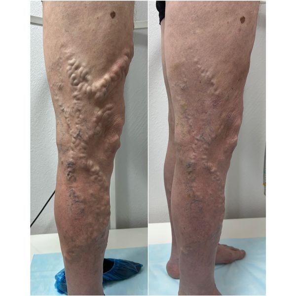 Состояние через неделю после первого этапа лечения (ЭВЛО) Состояние через неделю после первого этапа лечения (ЭВЛО)