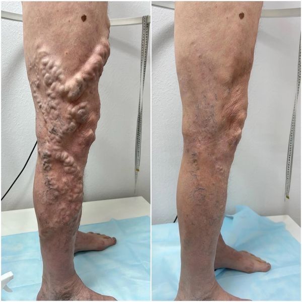 Слева — состояние до всего лечения, справа — через 2 месяца после проведения 2-го этапа (минифлебэктомии) Слева — состояние до всего лечения, справа — через 2 месяца после проведения 2-го этапа (минифлебэктомии)