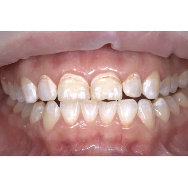 Состояние зубов до лечения: белые пятна на центральных резцах, стираемость и клиновидные дефекты