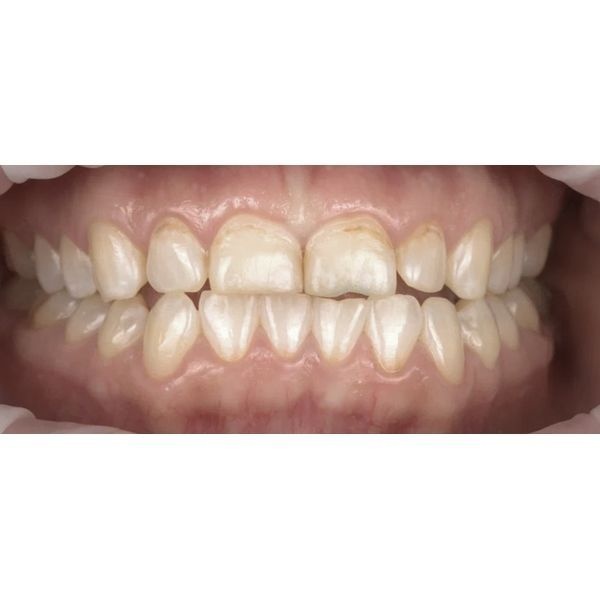 Состояние зубов спустя месяц после микроабразии и реминерализирующей терапии 