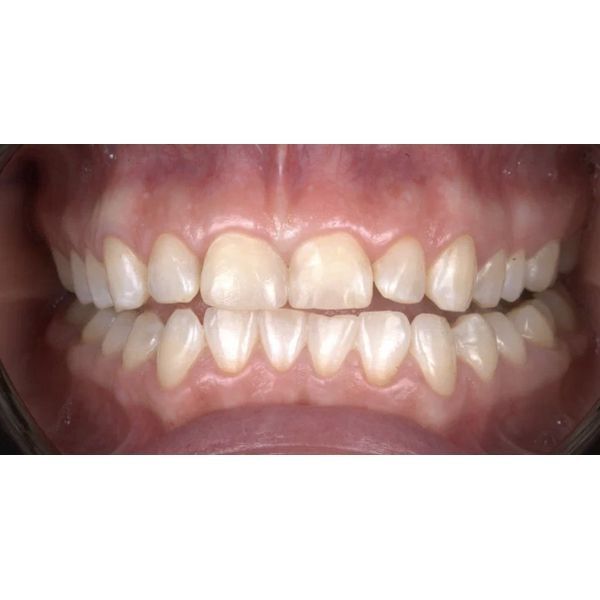 Состояние зубов после проведённого лечения