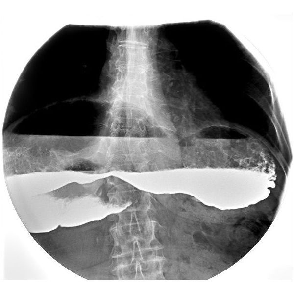 Рентгеноскопия желудка до операции