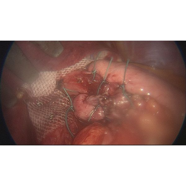 Установленный сетчатый эндопротез