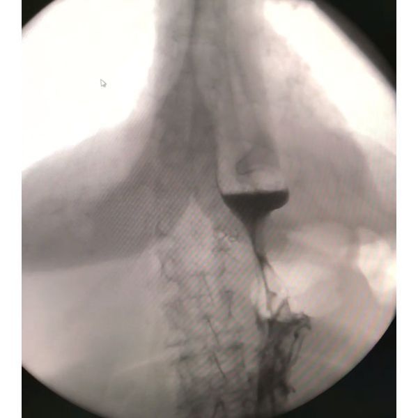 Рентгеноскопия желудка после операции