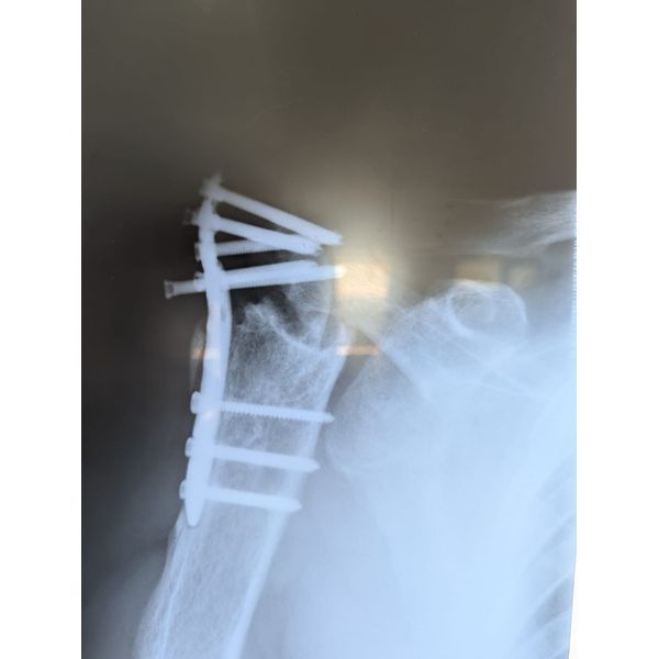 Рентгенограмма до операции: видна миграция винтов, рассасывание головки. Рентгенограмма до операции: видна миграция винтов, рассасывание головки.