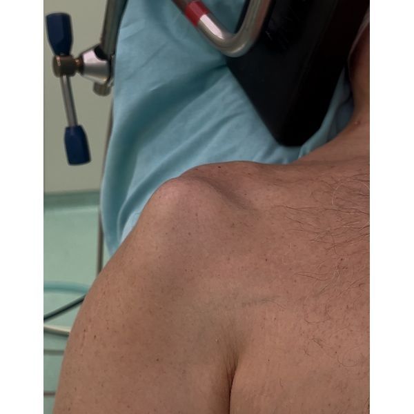 Плечевой сустав до операции: видна пластина, которая выпирает Плечевой сустав до операции: видна пластина, которая выпирает