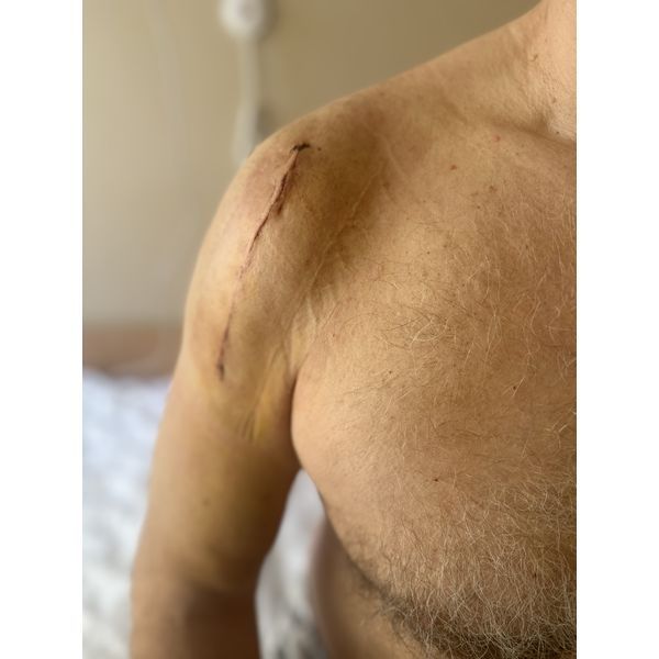 Плечевой сустав после операции. Плечевой сустав после операции.