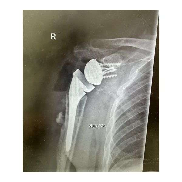 Рентгенограмма после операции Рентгенограмма после операции