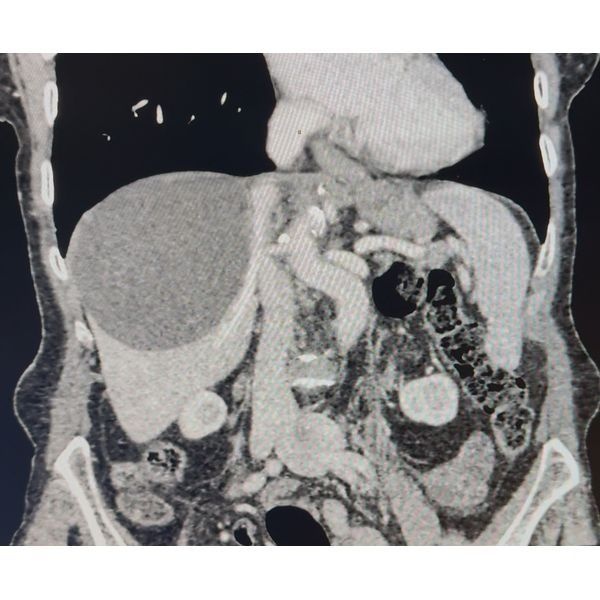 КТ-снимок кисты правой доли печени КТ-снимок кисты правой доли печени
