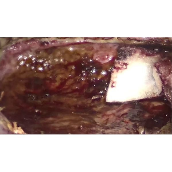 Зона операции после удаления кисты Зона операции после удаления кисты