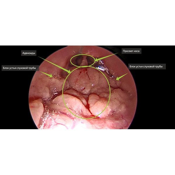 Эндоскопия полости носа и носоглотки