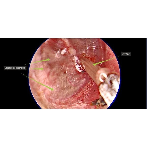Удаление экссудата (жидкости) из барабанной полости