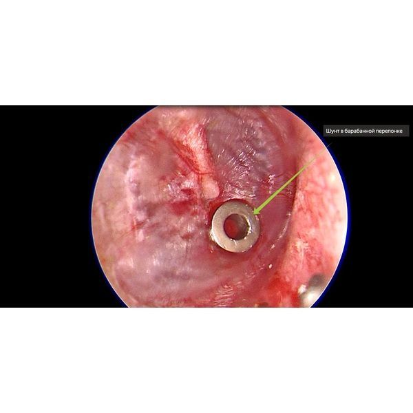 Шунт в барабанной перепонке
