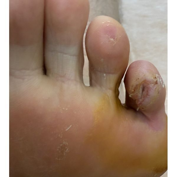 Через 11 дней после лечения Через 11 дней после лечения