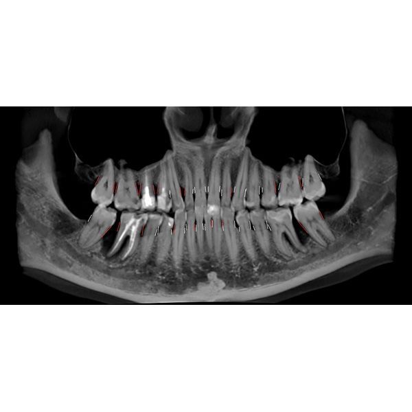 КЛКТ до лечения