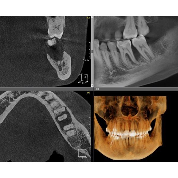 Зуб 3.6 до лечения
