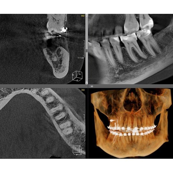 Зуб 3.6 через 2 года после лечения: стабильный результат