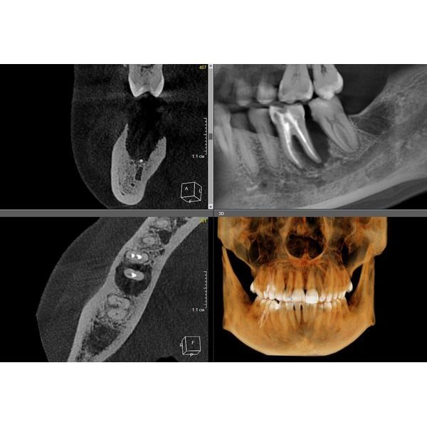 Зуб 4.6 до лечения