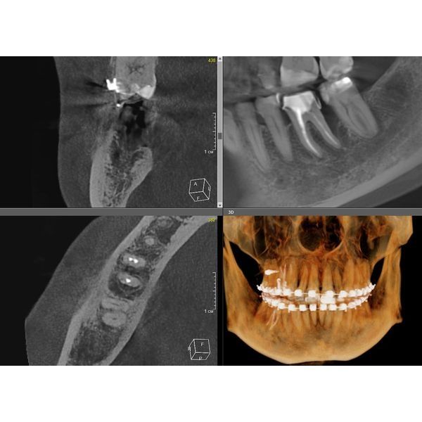 Зуб 4.6 через 2 года после лечения: стабильный результат