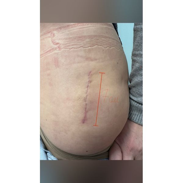 Кожа в области тазобедренного сустава после операции: разрез 7 см